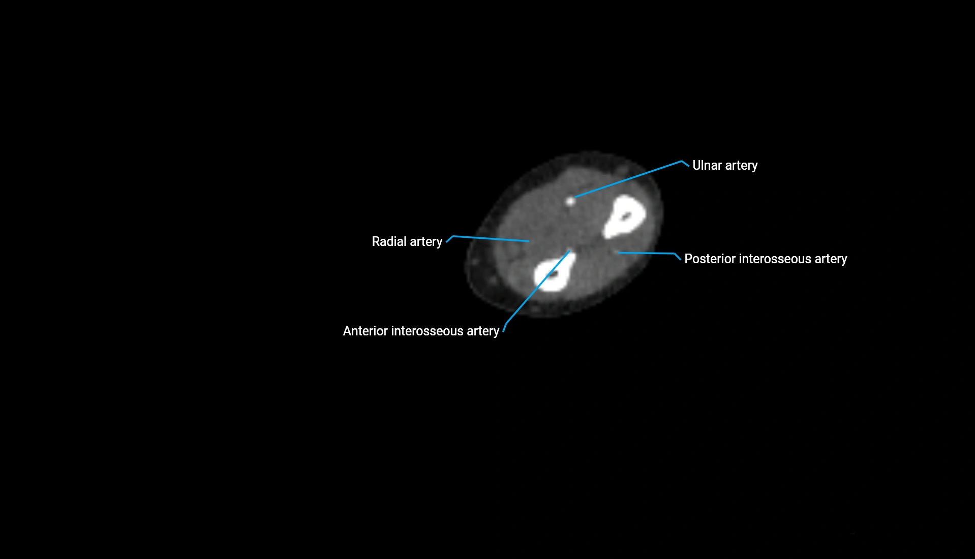 CTA upper limb axial cross sectional anatomy labelled image 139 (2).webp
